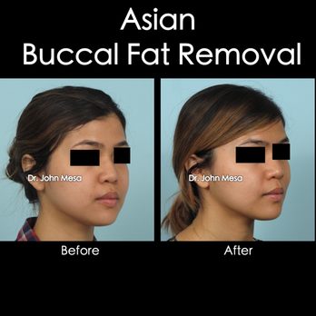 John Mesa - Buccal Fat Removal - Cosmetic Surgeons Near Me - Manhattan, New York John Mesa - Buccal Fat Removal - Cosmetic Surgeons Near Me - Manhattan, New York