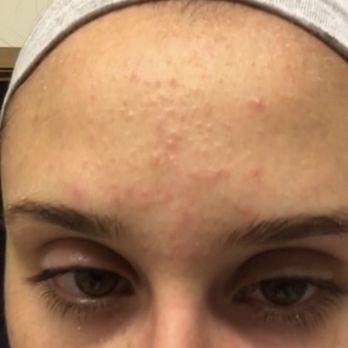 Skin Care By Casey - Before - Skin Care Near Me - Seattle, Washington