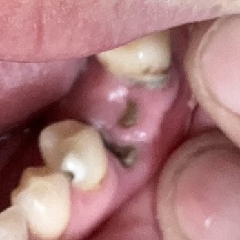 Reisman Alan, DDS - What is left of the rotting tooth he was supposed to remove has now affected both teeth next to it. - Oral Surgeons Near Me - Louisville, Colorado Reisman Alan, DDS - What is left of the rotting tooth he was supposed to remove has now affected both teeth next to it. - Oral Surgeons Near Me - Louisville, Colorado