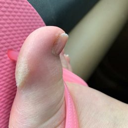 All he did was pretty much put the gel callus remover medicine and rubbed it off. No filing. All he did was pretty much put the gel callus remover medicine and rubbed it off. No filing.