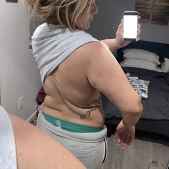 BelleSculpt - This is after the fat transfer and lipo on my back an arms and it looks much worse than before the procedure! Now I have extra rolls great - Body Contouring Near Me - Tulsa, Oklahoma BelleSculpt - This is after the fat transfer and lipo on my back an arms and it looks much worse than before the procedure! Now I have extra rolls great - Body Contouring Near Me - Tulsa, Oklahoma