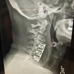 Christian Athanassious, MD - Multi-Level ACDF of my actual cervical spine. Nice work Dr. Athanassious !