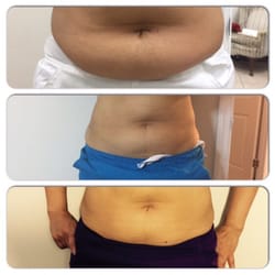 Venus Threading Eyebrow & Skin Care - Cavitation