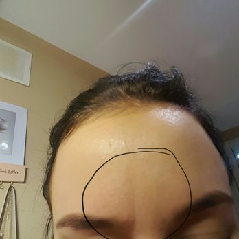 Glow Day Spa - Day 3 of botox and no change ...Lines still there - Eyelash Service Near Me - Barrie, Ontario