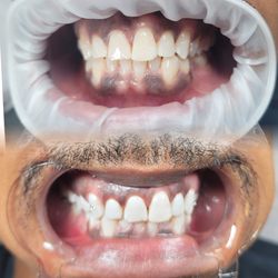 Dreamfillz - Teeth Whitening