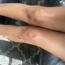 The bruises of when she was tossing a 133 pound girl around , pushing me to the ground The bruises of when she was tossing a 133 pound girl around , pushing me to the ground