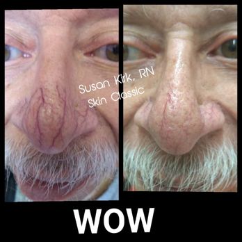 North Star Esthetics - Skin Classic dehydration treatment - Skin Care Near Me - Seminole, Florida North Star Esthetics - Skin Classic dehydration treatment - Skin Care Near Me - Seminole, Florida