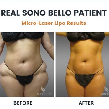 Sono Bello - Cosmetic Surgeons Near Me - Bellevue, Washington Sono Bello - Cosmetic Surgeons Near Me - Bellevue, Washington