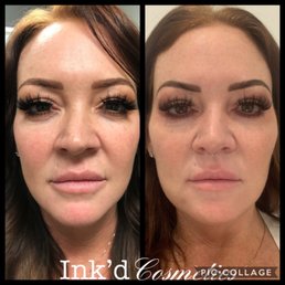 Left pic is before Right pic is after PDO Threads, Cheek Filler, Lip Fuller, Jaw Line Filler, and of course Botox. My face no longer sags. Left pic is before Right pic is after PDO Threads, Cheek Filler, Lip Fuller, Jaw Line Filler, and of course Botox. My face no longer sags.