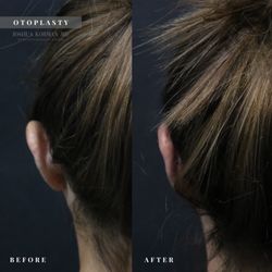 Korman Plastic Surgery & Wunderbar MedSpa - Otoplasty - "ear pinning surgery"