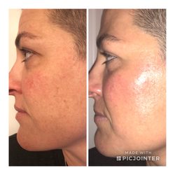 Laguna Med Spa - Before and after with only 1 dermaplane treatment
