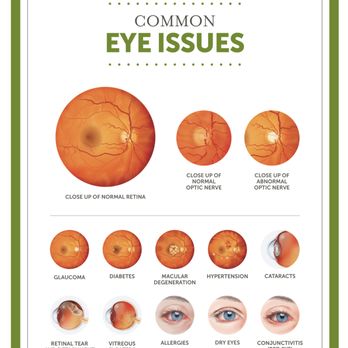 Pearle Vision - Common Eye Issues that we treat. - Optometrists Near Me - La Habra, California