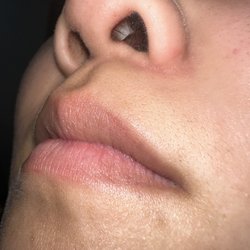Thuan T Nguyen MD - Rhinoplasty