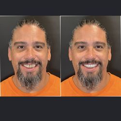 Aria Dental Implant Center - Another before and after with a confident smile.