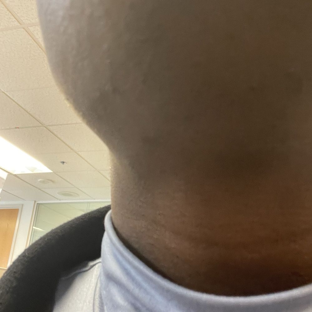 Ideal Image Vancouver - Cheek, Chin and Neck Burns post procedure - Laser Hair Removal Near Me - Vancouver, Washington Ideal Image Vancouver - Cheek, Chin and Neck Burns post procedure - Laser Hair Removal Near Me - Vancouver, Washington
