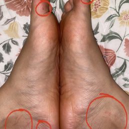 Cuts and scrapes from the pumice sponge