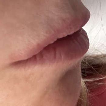 StudioMD - The duck look - product is above the lip which I hate and asked her not to do - Laser Hair Removal Near Me - New York, New York