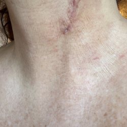 Bonvallet Todd C MD - Taken 20 days after surgery
