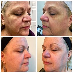 Studio G Aesthetics - Phenomenal results after just ONE treatment with our ICON laser! Two treatments left. (Photos are not retouched)