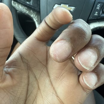 Pretty Nails - Left middle finger. Cut into the nail bed by using a nail tip to pull off the nail. - Nail Salons Near Me - Indianapolis, Indiana Pretty Nails - Left middle finger. Cut into the nail bed by using a nail tip to pull off the nail. - Nail Salons Near Me - Indianapolis, Indiana