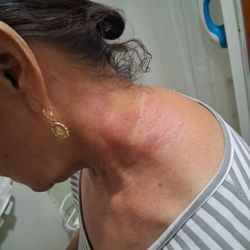 Gonzaba Medical Group - Reaction to prescribed lotion