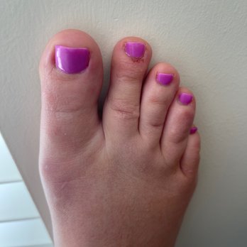 Ice Nails - Where the electric file when removing my old gel damaged my toes. - Nail Salons Near Me - Indianapolis, Indiana Ice Nails - Where the electric file when removing my old gel damaged my toes. - Nail Salons Near Me - Indianapolis, Indiana