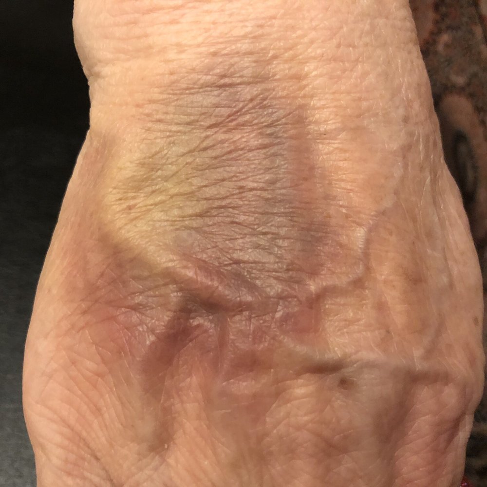 Innovative Express Care - Three try to get blood. - Urgent Care Near Me - Chicago, Illinois Innovative Express Care - Three try to get blood. - Urgent Care Near Me - Chicago, Illinois