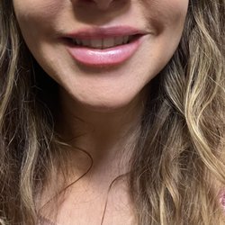 Allegro Med Spa - Lips