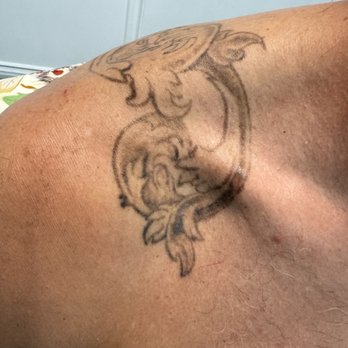 MS Slim - After 2 treatments - Skin Care Near Me - Irvine, California