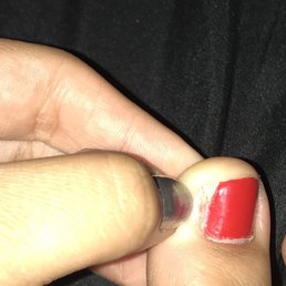 My ingrown toenail that is now missing much of the toenail it had before going here. My ingrown toenail that is now missing much of the toenail it had before going here.