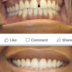 Pure Smiles - # Invisalign