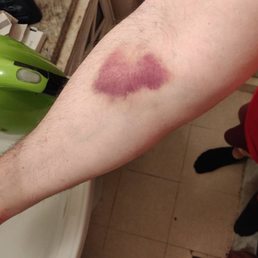 2 weeks afterward Quest Diagnostics too blood sample clot is still visible.