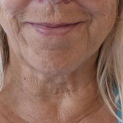 Rejuvenation Skin Wellness & Aesthetics - Here is a year later still recovering from the Morpheus8 Treatments. Still very disappointed.