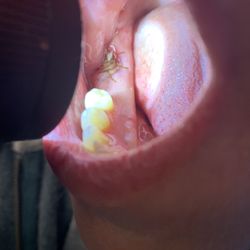 Central Sound Oral, Facial & Implant Surgery - Tooth extraction.