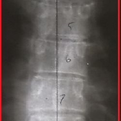 Adams Parker J Dr Chroprctr - Thoracic vertebrae starts to bend to a side, making me have indigestion and taking so much naps every single day, feeling very fatigued.