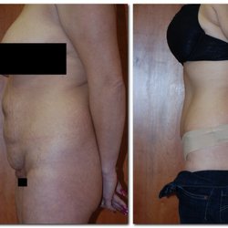 Wellesley Cosmetic Surgery - Before and after a tummy tuck