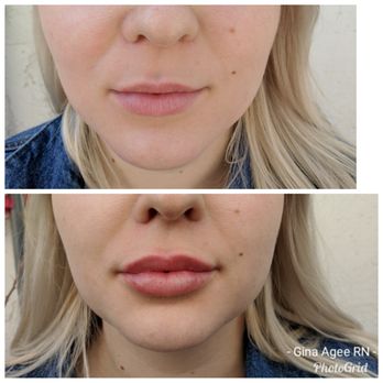 Essence Skin Spa - Lips! - Medical Spas Near Me - Gilbert, Arizona