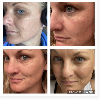 Columbus Aesthetic & Plastic Surgery - BBL results! - Cosmetic Surgeons Near Me - Upper Arlington, Ohio