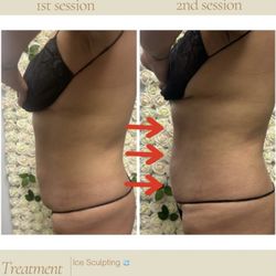 Dolce Beaute - Ice sculpting treatment is a natural way of sculpting and toning the body while detoxing.