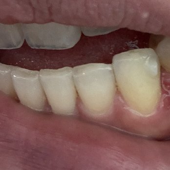 Haru Dental - The initial scarring I had right after the cleaning. - Cosmetic Dentists Near Me - Torrance, California
