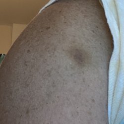 Ama Spa - Left shoulder