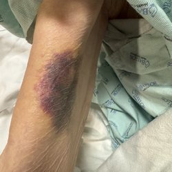 Mustang Creek Estates Of Keller - Bruised arm