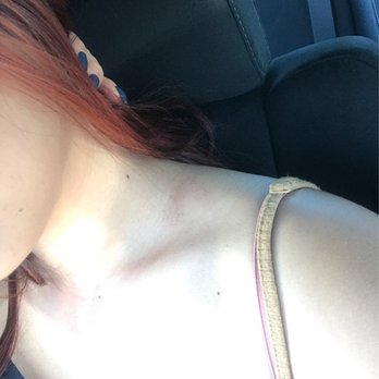 Lucky Feet - Bruises and marks caused by unprofessional and unqualified workers - Beauty & Spas Near Me - Westminster, California Lucky Feet - Bruises and marks caused by unprofessional and unqualified workers - Beauty & Spas Near Me - Westminster, California