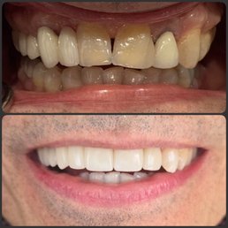 Before and after Dr Davidson's work. Four crowns and a bridge.