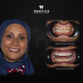 Dentics Cancun - Veneers - Cosmetic Dentists Near Me - Cancún, ROO