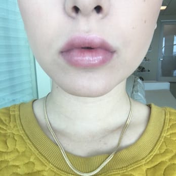 Cure - And after! (They are still a little swollen) but should take another week to be completely fabulous! Again, thanks Claire! - Medical Spas Near Me - Malibu, California