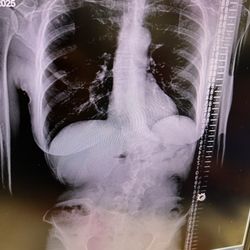 Payam Moazzaz, MD - My scoliosis before the surgery