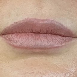 Before (lip on right side of photo is uneven both top and bottom) Dr Danielpour corrected that. Nobody had ever pulled that off.
