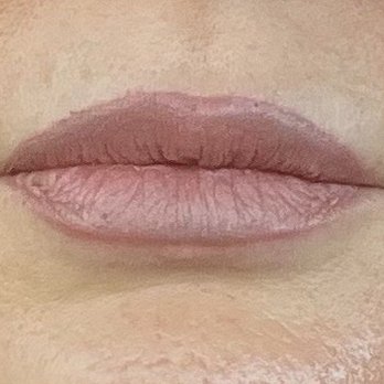 Beverly Hills Plastic Surgery Group - Before (lip on right side of photo is uneven both top and bottom) Dr Danielpour corrected that. Nobody had ever pulled that off. - Cosmetic Surgeons Near Me - Beverly Hills, California