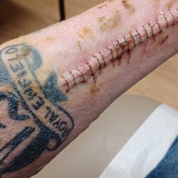 Richmond University Medical Center - The wound at two weeks.
